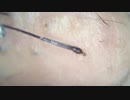 007ショートバージョン 高倍率毛抜き Doctor tweezers Remove hair microscope 毛抜先生 닥터 족집게