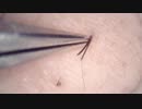 008 短い毛にも果敢に挑む 高倍率毛抜き Dr.tweezers Remove hair microscope 毛抜先生 닥터 족집게