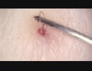 sample02 埋没毛の発掘 高倍率毛抜き Dr.tweezers Remove hair microscope 毛抜先生 닥터 족집게