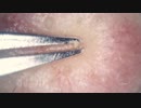013 極小角栓を引き抜く 高倍率毛抜き Dr.tweezers Remove hair microscope 毛抜先生 닥터 족집게