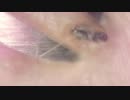 018 限界倍率で埋没毛との攻防 高倍率毛抜き Dr.tweezers Remove hair microscope 毛抜先生 닥터 족집게
