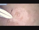 021 小さな角栓をポロリ 高倍率毛抜き Dr. tweezers Remove hair microscope 毛抜先生 닥터 족집게