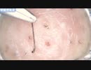 022 毛抜まとめ 高倍率毛抜き Dr. tweezers Remove hair microscope 毛抜先生 닥터 족집게
