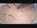 023 30分耐久毛抜き 高倍率毛抜き Dr. tweezers