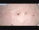 024 角栓と見せかけたアレ Dr. tweezers 高倍率毛抜き Pull out