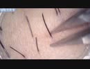 025 30分の見入ってしまう毛抜き  Dr. tweezers 高倍率毛抜き Pull out