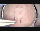 028 髭抜き  Dr. tweezers 高倍率毛抜き Pull out