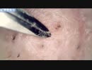029 角栓的な何か Dr. tweezers 高倍率毛抜き Pull out