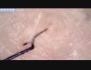 030 角栓毛  Dr. tweezers 高倍率毛抜き Pull out