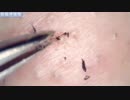 031 勝率の高い角栓毛との闘い  Dr. tweezers 高倍率毛抜き Pull out
