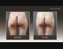 脂肪吸引でお尻を小さく｜お尻の張り出しもスッキリ