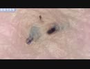 034 角栓・毛根、超拡大ダイジェスト  Dr. tweezers 高倍率毛抜き Pull out