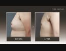 【女性化乳房】男性の胸の膨らみを脂肪吸引で改善できます