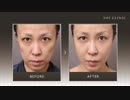顔の脂肪注入＜SRF注入＞｜症例写真まとめ