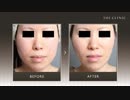 脂肪吸引で頬のたるみを解消｜症例写真