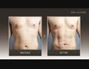 脂肪吸引の症例写真【お腹の脂肪吸引 男性編】