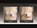 授乳後のバストケアに豊胸を! ｜症例写真