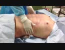 【男性向け】お腹の脂肪吸引で腹筋を作る／横浜院院長・加藤 敏次医師