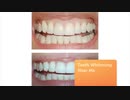 Florida Dental Care of Miller : Teeth Whitening Near You (305-596-0104)