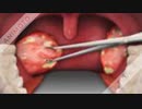 Tonsil_stone_removal_kit
