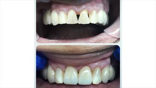 Dental American Group : Dental Veneers in Kendall West, FL