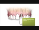 Advanced Dentistry : Dental Implant in Coral Springs