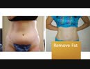 Tummy Tuck Los Angeles, CA | Liposuction Centers