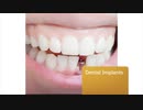Brar Dentistry - Dental Implants in South Elgin, IL