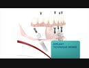 Progressive Dental And Associates - All On 4 Dental Implants in Matteson, IL