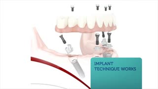 Progressive Dental And Associates - All On 4 Dental Implants in Matteson, IL