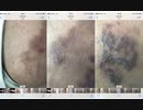 肌が茶色になる病気■2020年5月21日画像から■4月8日-5月初旬迄服用抗ヘルペスウィルス剤(anti-Herpes zoster)停止後.約７割回復も完治する迄あと３ヶ月は「使い捨て生活」継続決心