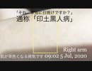 奇病 通称「印土黒人病」■肌が薄茶-茶色になるウィルス性の病気です■１９０４年以来１１６年振リ流行中