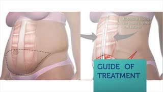 Smartlipo Los Angeles By Liposuction Centers