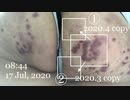 anti-Herpes zoster(抗ヘルペス剤,2020.4.7-6.3),Prednisolone(プレドニゾロン/プレドニン,2020.6.3-7.12)停止後３度目右太腿に③copy