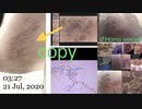202007210327■ワキガ術後みたいな脇下(これより濃い肌だと気が付かない？
