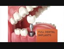 Full Dental Implants in Lackawanna, NY | Southtowns Dental