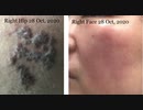【WHITE ONLY FOREVER】Herpes&heat urticaria(温熱蕁麻疹) on my face&body after bath time