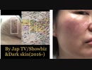 【回覧板】金原楓ちゃん大丈夫?芸能界&チビ&ブ男連中に遣われちゃって(2016.9.30)Memo:Herpes&Herpes zoster suffered by Jap TV/Showbiz