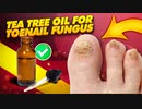 How To Use Tea Tree Oil for Toenail Fungus Effectively !