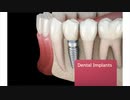 Bonita Del Rey Dental Care : Dental Implants Chula Vista CA