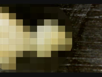 【結石注意】扁桃結石の観察