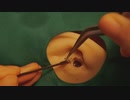 耳に差し込まれた医師を取り除く 耳鼻咽喉科ASMR