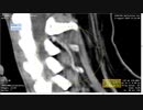 UMA 首の内側に7cmのワームMRI / CT画像