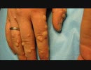 Apple Cider Vinegar for Warts: How To Use Apple Cider Vinegar for Wart Removal