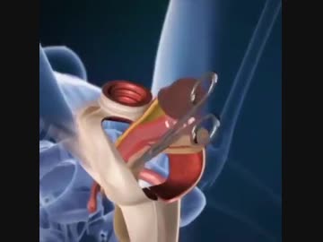 ホモと学ぶ性転換手術