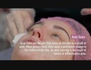 Best Acne Scar Treatment in Mumbai, Cost - Best Dermatologist in Mumbai for Acne Scars