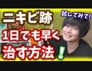 ニキビ跡を一日でも早く治す方法！！試してみて！