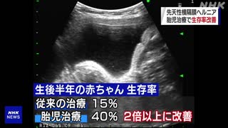 先天性横隔膜ヘルニア 胎児治療で“生存率 2倍以上に改善”