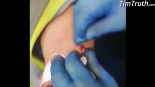 ワクチン接種者の腕から　“磁性体”　を摘出！