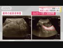 膵臓がん「午後の紅茶」で早期発見！